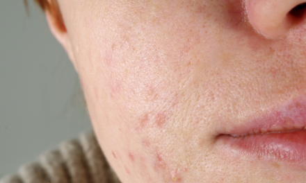 Acne Sufferers Actually Age More Slowly